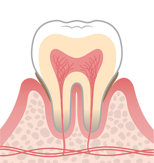 P1（軽度歯周炎）のイメージイラスト