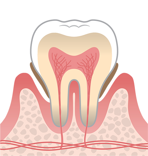 P2（中度歯周炎）のイメージイラスト