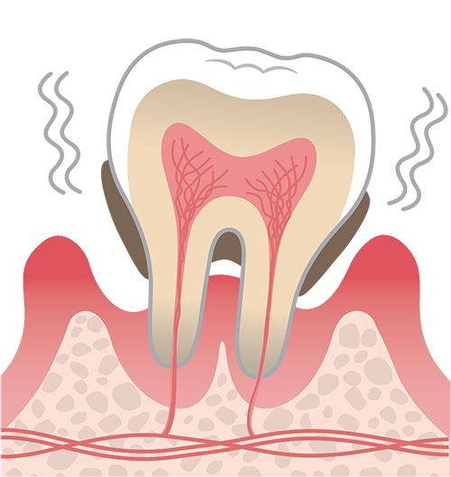 P3（重度歯周炎）のイメージイラスト